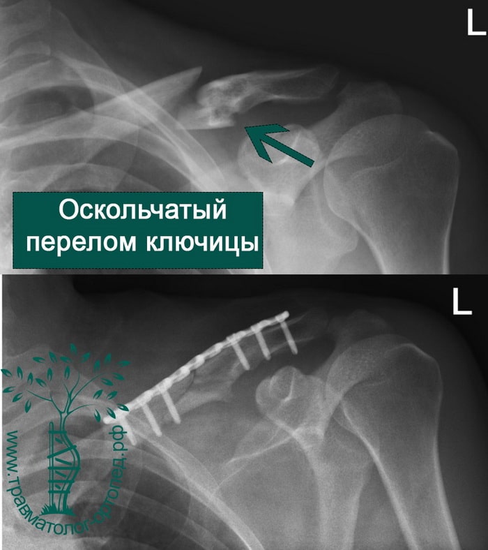 Сколько лечится ключица. Внутрикостный остеосинтез ключицы. Перелом диафиза ключицы. Винтообразный перелом ключицы. Перелом ключицы остеосинтез.