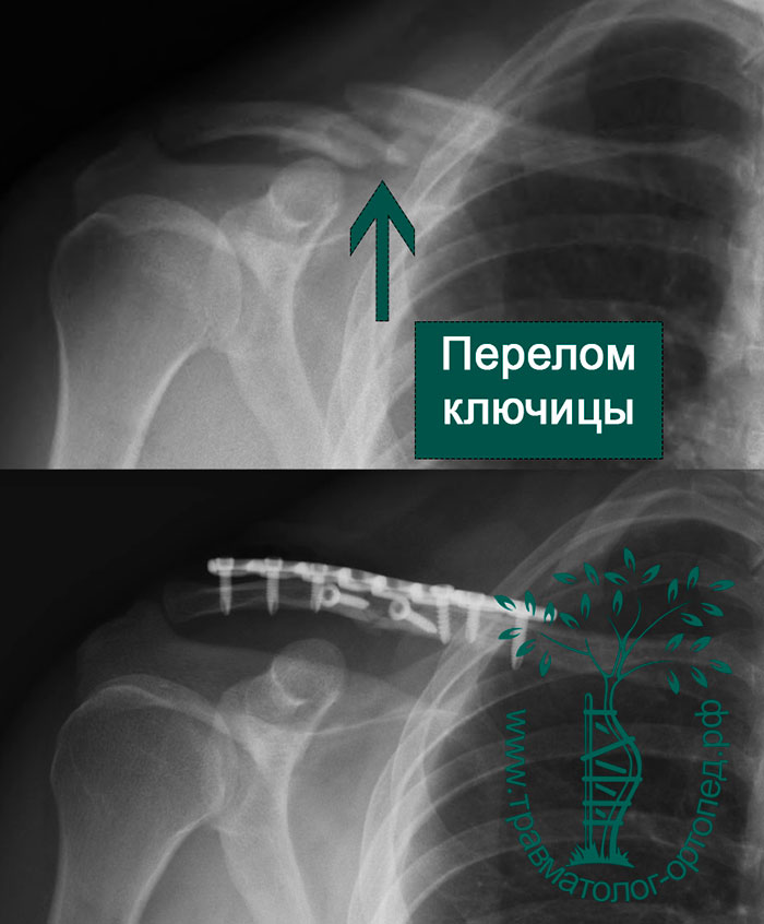 Сколько лечится ключица. Закрытый оскольчатый перелом ключицы. Перелом ключицы показания. Многооскольчатый перелом ключицы. Оскольчатый перелом ключицы рентген.