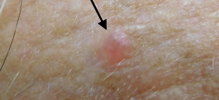 Базальноклеточная карцинома кожи фото начальная стадия