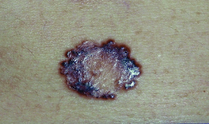 Базальноклеточная карцинома кожи фото начальная стадия