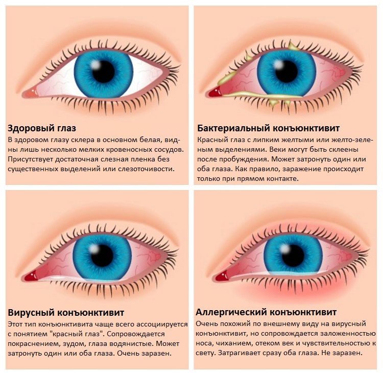 Конъюнктивит фото красного глаза