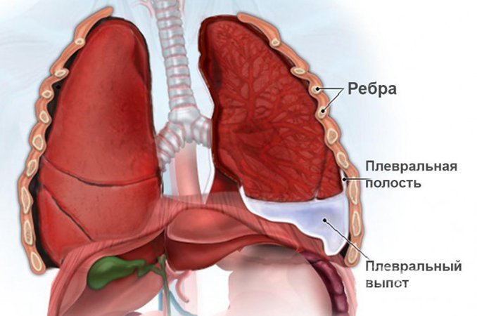 Плевральный выпот - скопление жидкости в полости между двумя слоями плевры