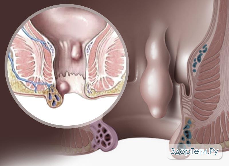 Тромбофлебит заднего прохода. Внешний геморроидальный узел. Опухоль анального отверстия. Геморрой в заднем проходе.