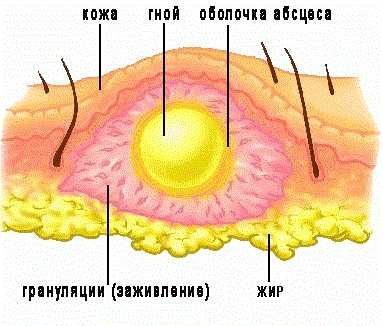 Абсцесс на ягодице фото