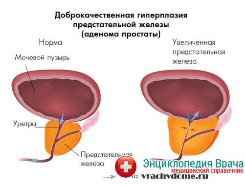 Стол при аденоме простаты