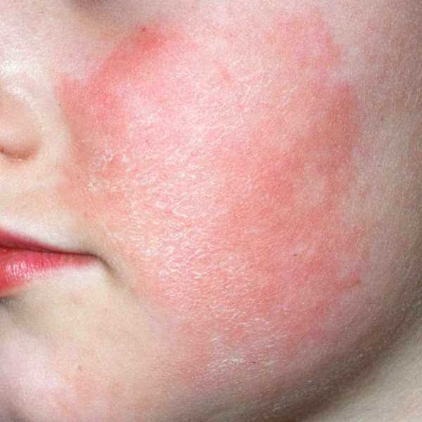Аллергия на металл на коже фото