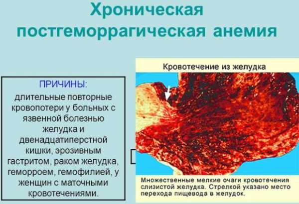 Постгеморрагическая анемия картинки