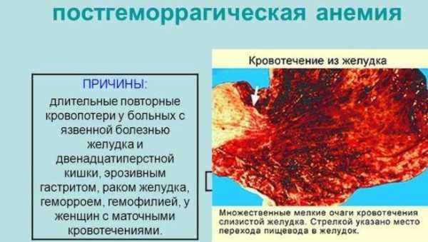 Постгеморрагическая анемия картинки