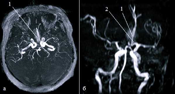 Аневризма головного мозга фото