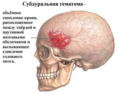 Аневризма сосудов головного мозга фото