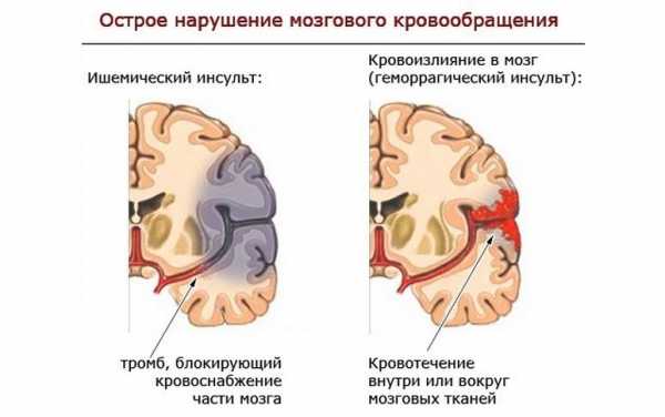 Презентация аневризмы сосудов головного мозга