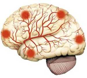 Аневризма сосудов головного мозга фото
