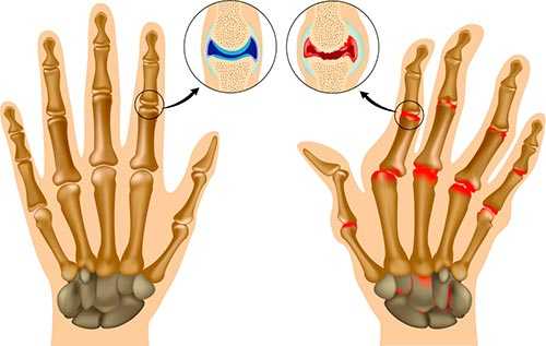 Артрит и артроз фото