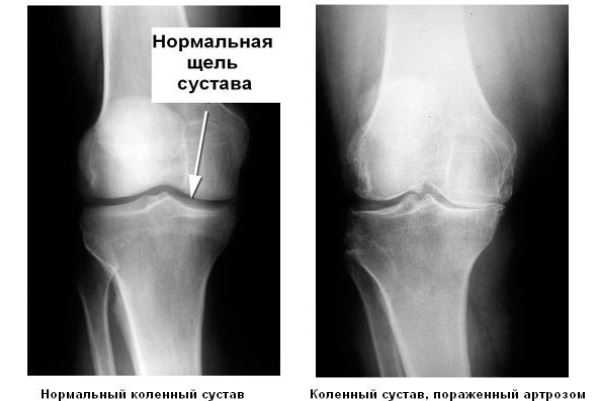 Лечение гонартроза коленного сустава 1 степени схема