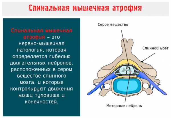 Спинальная мышечная атрофия презентация