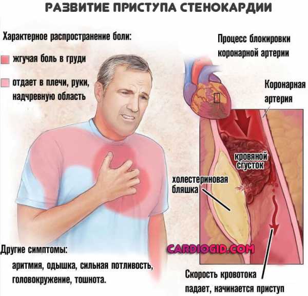 Где болит при невралгии грудного отдела фото