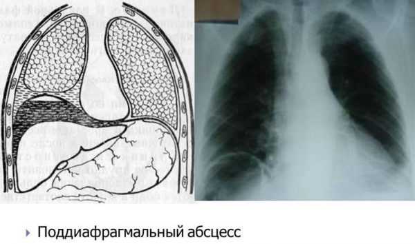 Что находится справа под ребрами у человека сбоку болит фото как лечить