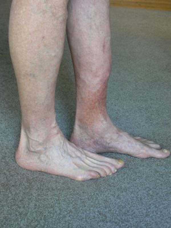 Раны на ногах при диабете фото