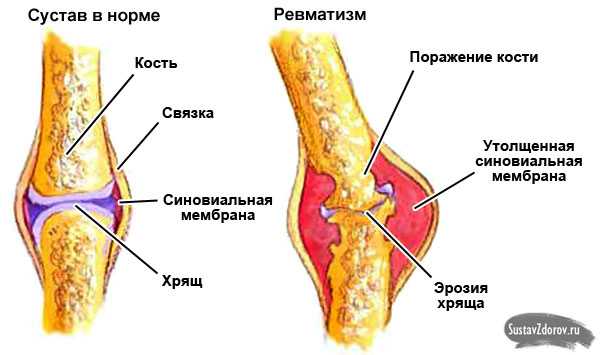 Ревматизм что