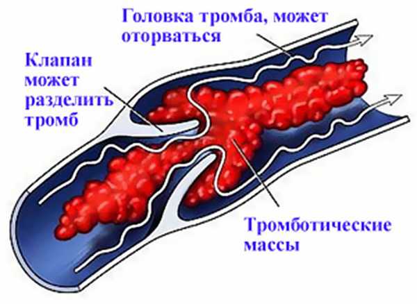 Болезни сосудов ног фото