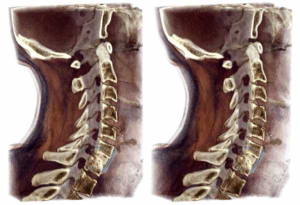 Шейный хондроз фото