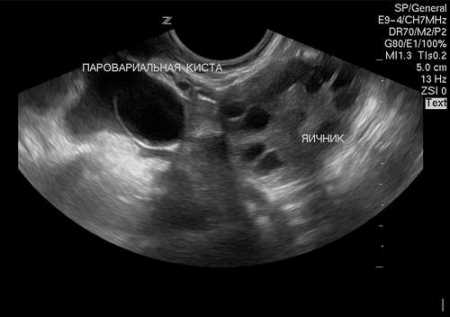 Параовариальная киста на узи фото