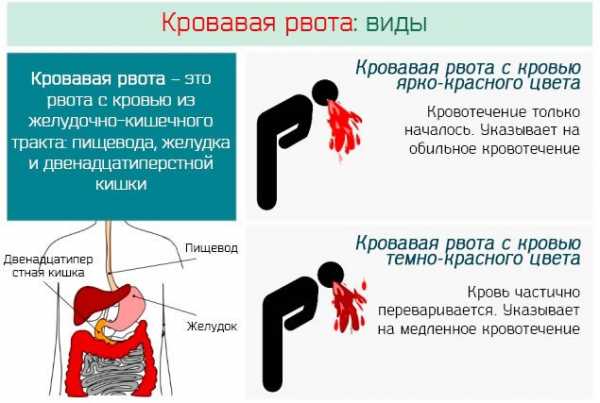 Рвота с кровью фото