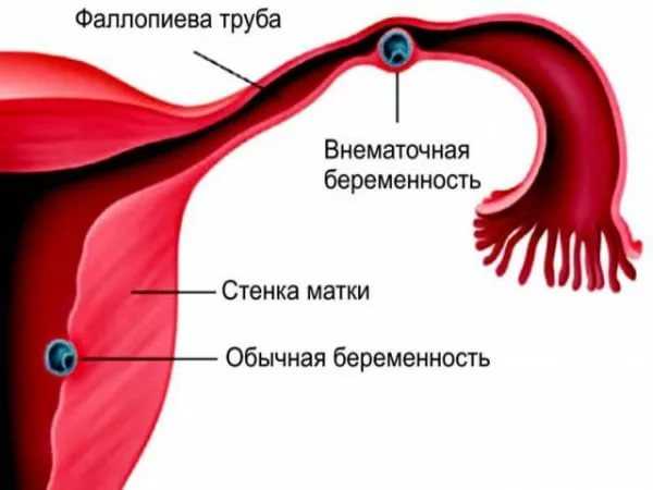 Что делают врачи при внематочной беременности на ранних сроках