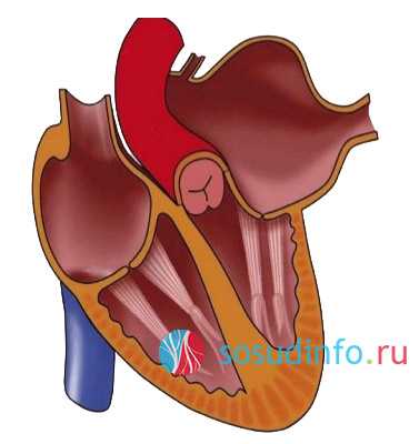 Гипертрофия левого желудочка сердца фото