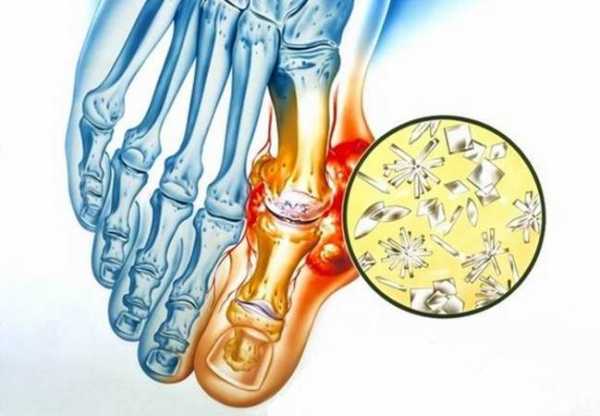 Подагра у женщин картинки