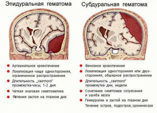 Сотрясение головного мозга карта вызова смп шпаргалка