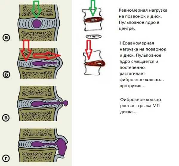 Грыжа диска l5 s1 фото