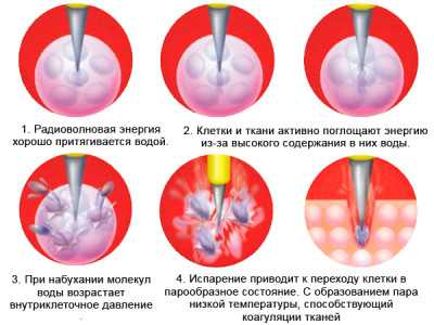 Ректоцеле 1 степени фото