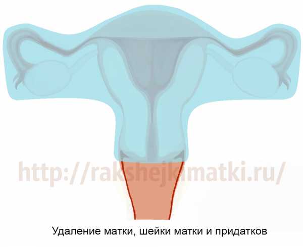 Удаление матки и сальника