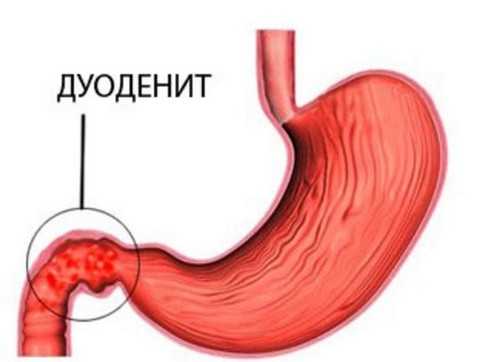 Схема лечения дуоденита