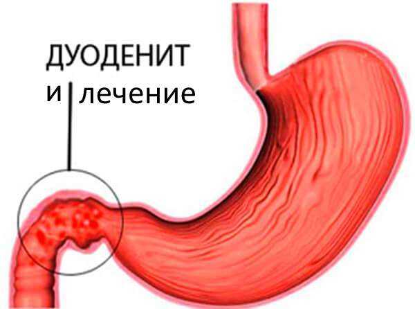 Лечение дуоденита препараты схема лечения