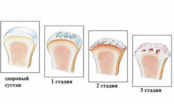 Гонартроз 2 степени фото