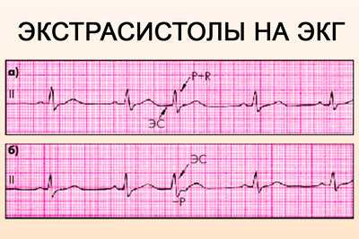 Наджелудочковая экстрасистолия экг фото