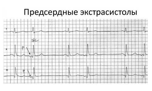 Экстрасистолия на фоне невроза