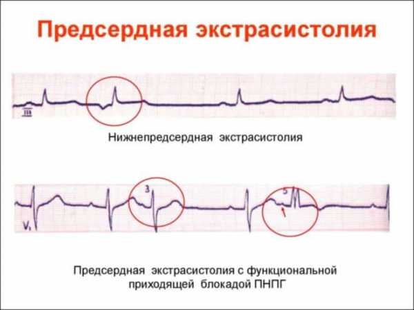 Экстрасистолия на фоне невроза