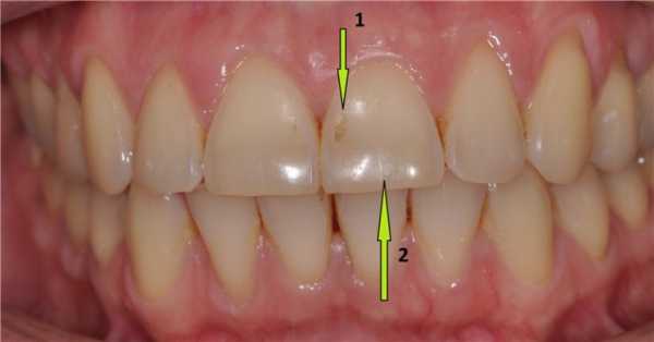 На зубах стерлась эмаль фото