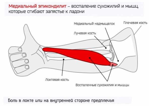 Фото эпикондилита локтевого сустава