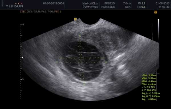 Дермоидная киста на узи фото