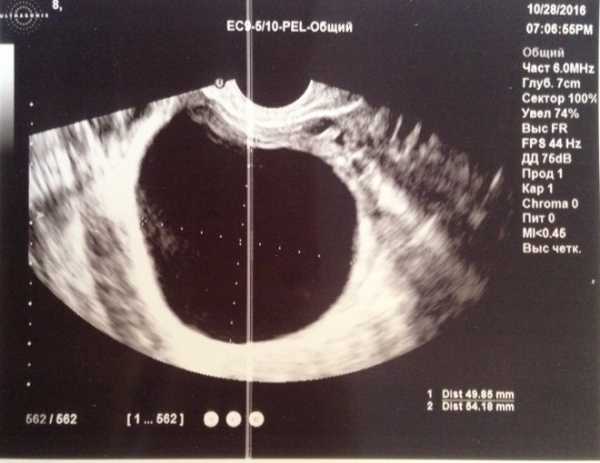 Эндометриоидная киста левого яичника фото