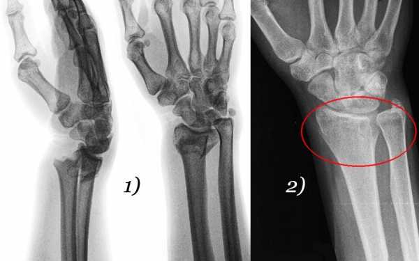 Лучевая кость на руке фото где