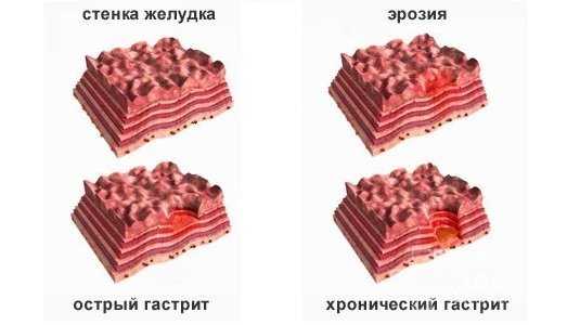 Эрозии желудка мкб 10. Эрозивно геморрагический гастрит. Острый и хронический гастрит. Острый геморрагический гастрит. Острый гастрит фотография.