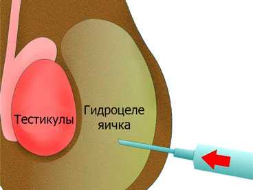 Гидроцеле яичка у мужчин фото