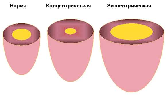 Гипертрофия левого желудочка фото