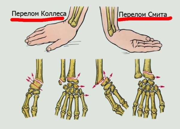 Что можно нарисовать на гипсе на руке