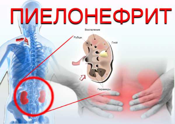 Лечение гломерулонефрита схема рекомендации методические